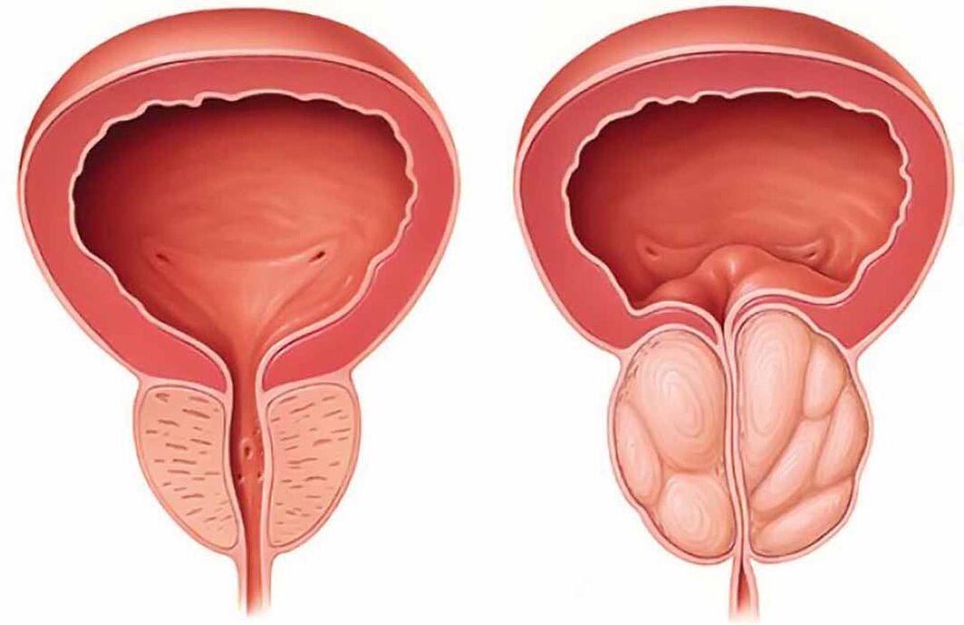 Próstata normal e inflamación da glándula prostática (prostatite crónica)