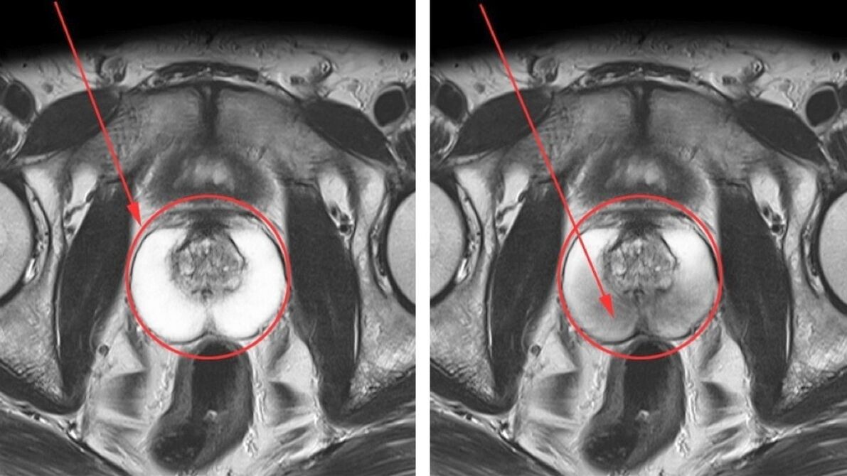 Ultrasóns para prostatite crónica próstata sa (esquerda) e inflamada (dereita)