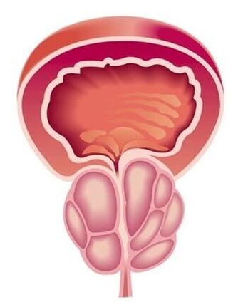 Síntomas de prostatite en homes