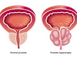 Próstata normal e inflamada