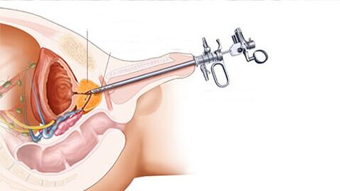 Tratamento cirúrxico da prostatite